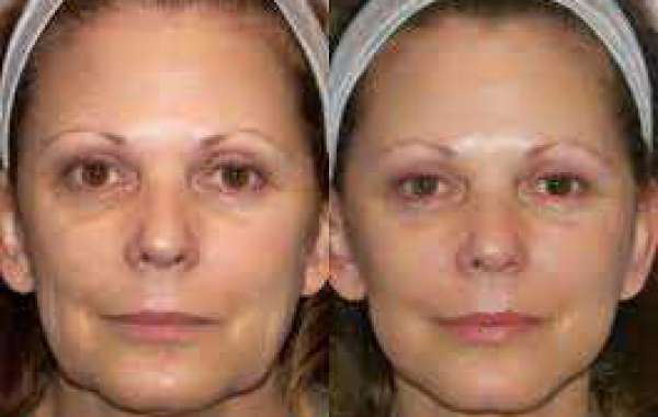 What is Radiofrequency (RF) Microneedling?